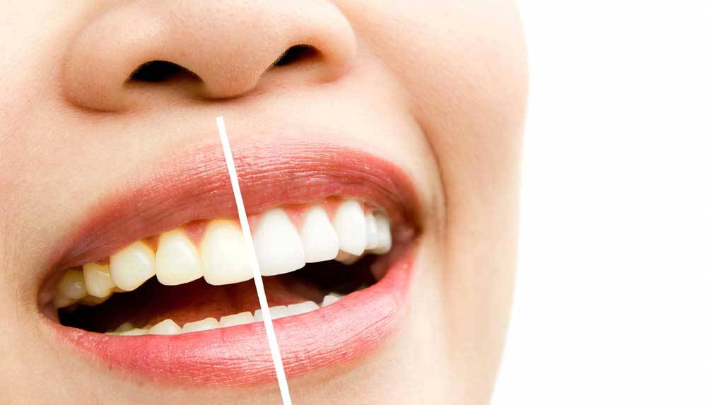 ¿El blanqueamiento dental se aplica para todos?