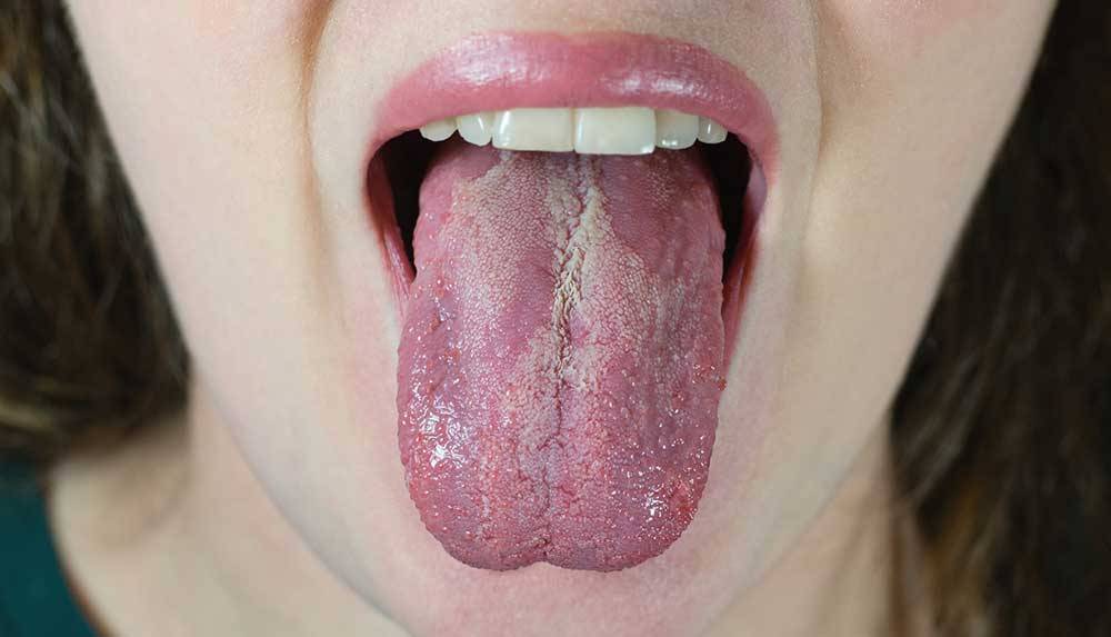 “Me diagnosticaron candidiasis oral; ¿qué es y por qué lo tengo?”